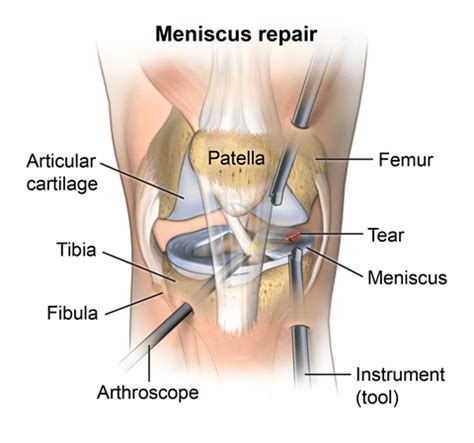 We did not find results for: Arthroscopy | Johns Hopkins Medicine Health Library