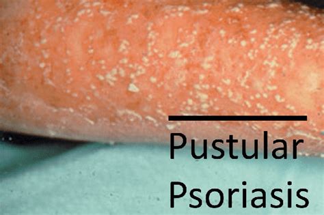 Warnings 6 Types Of Psoriasis And 4 Skin Conditions You Need To Know