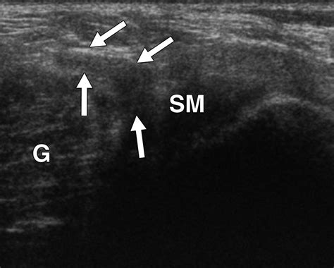Snapping Knee Imaging Findings With An Emphasis On Dynamic Sonography