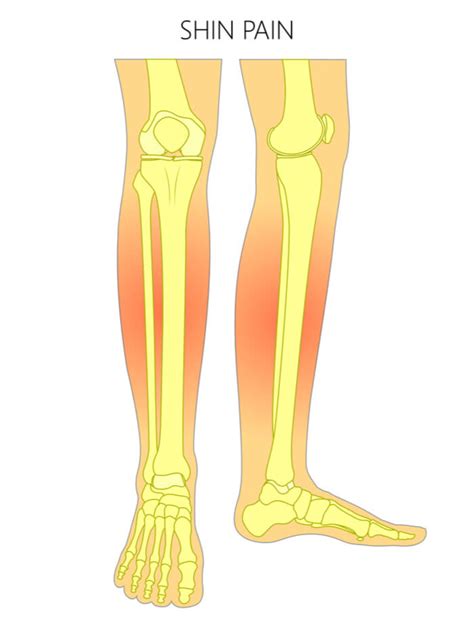 Shin Splints How To Treat And Prevent Lower Leg Pain All About Bone