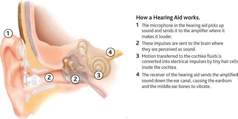 Mipla Binna Hearing Aids And Cochlear Implants
