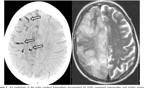 Figure 1 From Massive Cerebral Air Embolism After Bronchoscopy And