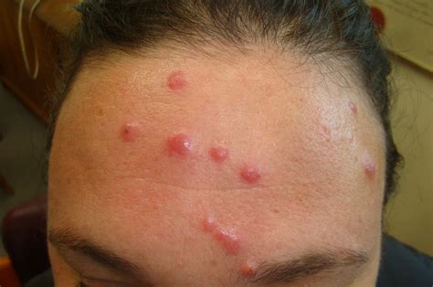 Consultations In Dermatology Bed Bug Bites