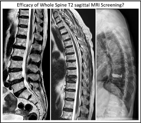 Mri Vs Ct Scan Diagnosing Spine Neck Injuries Degenerative Diseases Joseph Spine Kulturaupice