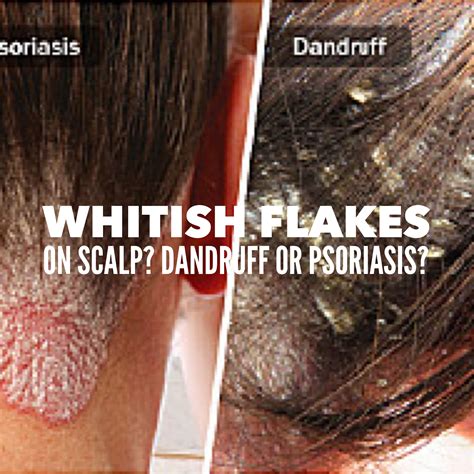 Soaplab Malaysia Flaky White Thing On Your Hair Is It Psoriasis Or