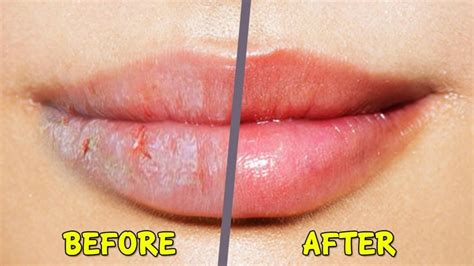 8 Homemade Remedies For Dry And Chapped Lips Skin Care Top News