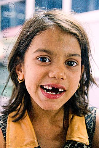 Little Girl With Missing Teeth Udaipur India