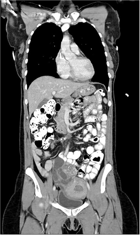 Coronal Cut Of Abdominal And Pelvic Ct With Oral And Intravenous