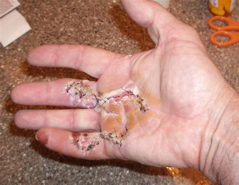 Dupuytren's contracture, also called viking disease, or palmar fibromatosis, is a fibrosing vitamin e, gamma interferon, dimethyl sulfoxide and splinting are not considered adequate treatments for. Dupuytren's contracture