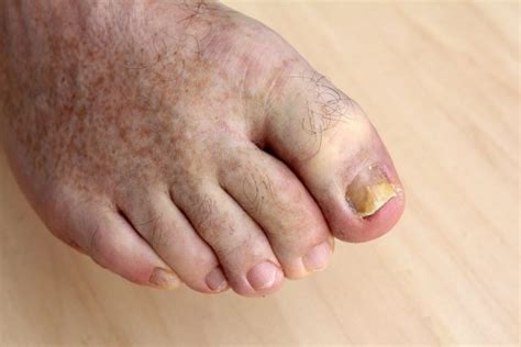 Erste hinweise darauf, ob und welche erkrankung hinter dem zungenbelag steckt, kann die farbe des belags liefern. Nagelpilz was tun? - Ursachen, Symptome, Behandlung