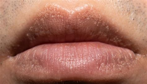 6 Must Try Remedies To Treat White Spots On Lips Or Fordyce Spots