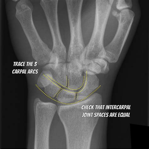 Wrist X Ray Review Illustrations Image
