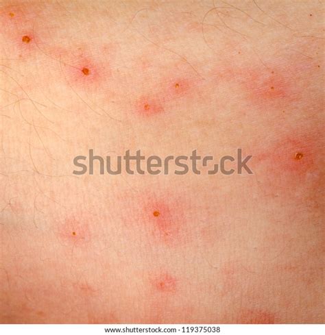 Ill Allergic Rash Dermatitis Eczema Skin Stock Photo Edit Now 119375038