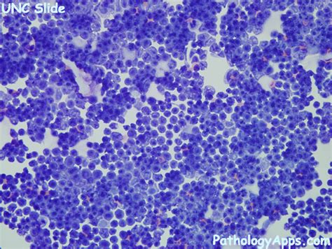 Acute Lymphoblastic Leukemia Csf Cytology