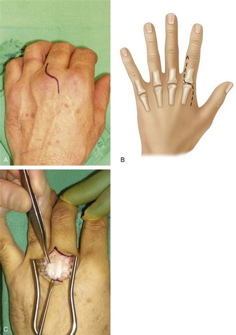 59 Pyrocarbon Implant Arthroplasty Of The Proximal Interphalangeal And
