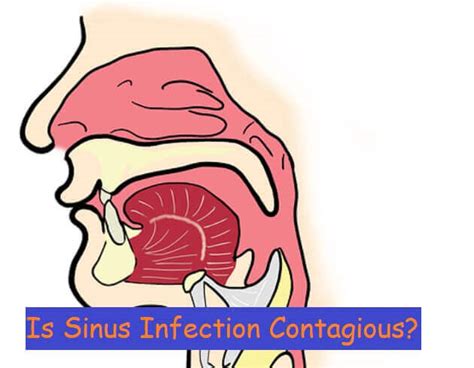 Is Sinus Infection Contagious 2023
