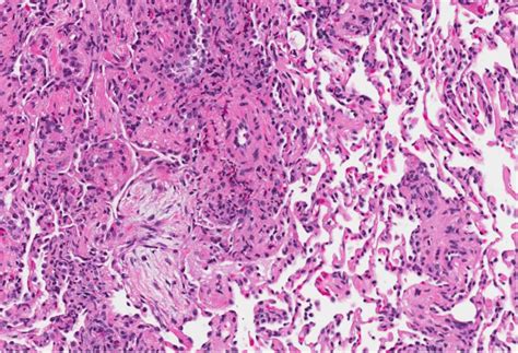 A Rare Case Report Of Polyangiitis Overlap Syndrome Granulomatosis
