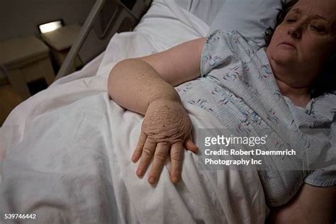 Lymphedema Arm Photos Et Images De Collection Getty Images