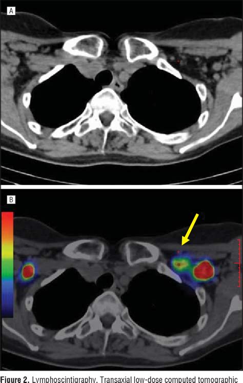 Recurrent Lymphangiectasia Of The Left Supraclavicular Fossa An