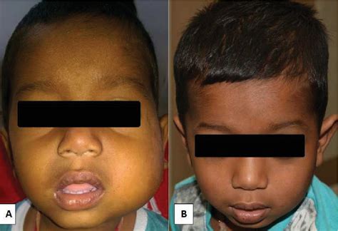 Figure 1 From Parotid Tuberculosis In A Young Child Causing Moth Eaten