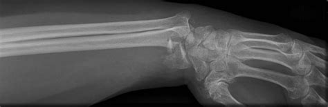 Barton Fracture Litfl Medical Eponym Library