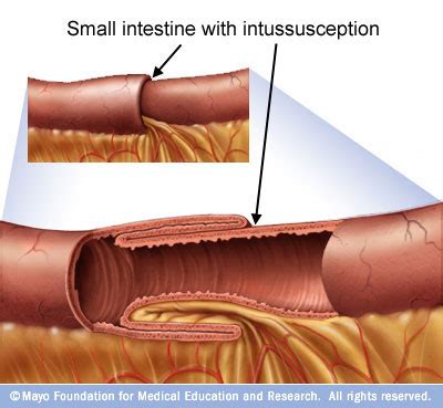 Pernah gak mendengar istilah ini? Sudiyatmo,MD Blog & Journal: Invaginasi (Intussusception) pada Dewasa