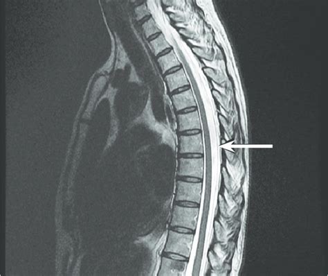Sagittal T2 Weighted MRI Of The Thoracic Spine Shows Fl Uid Collection
