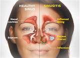 Ethmoid Sinusitis Treatment Photos
