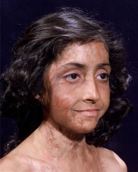 Burn Victim Gets Amazing Facial Reconstruction Pics