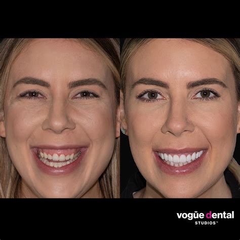 Picasso Porcelain Veneers Before And After Lauren H Vogue Dental