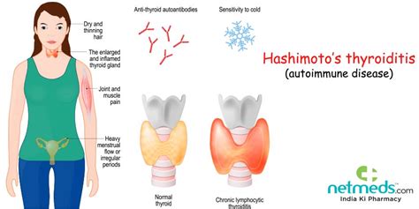 Hashimotos Disease Causes Symptoms And Treatment