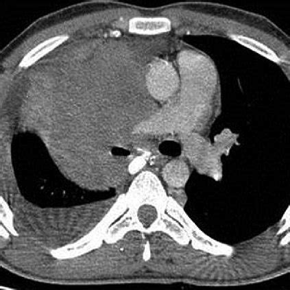 Contrast Enhanced Ctscan Of The Chest Showing A Right Hilar Mass With