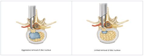 Discectomy 101 The Risks And Results To Understand Before Your Spine