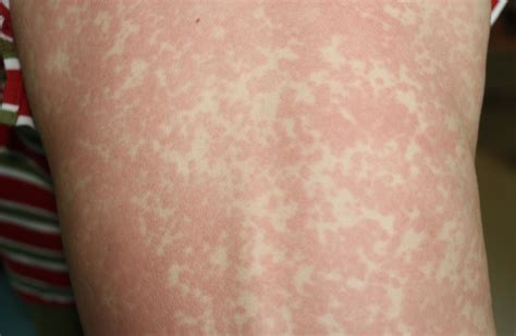 People With Measles Symptoms Advised To Isolate Themselves