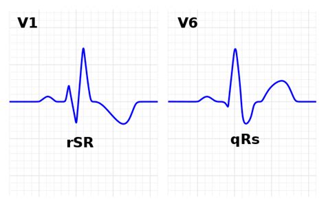 Ecg Characteristics Of An Intraventricular Block Subtype Rbbb Showing