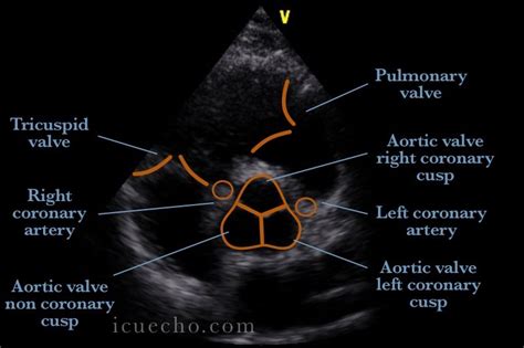 Psax Aortic Valve View Cardiac Sonography Ultrasound Diagnostic