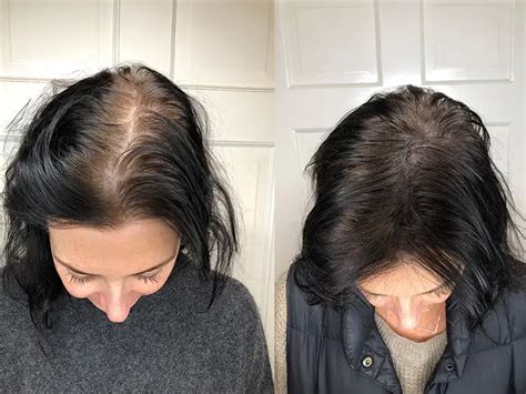 How To Deal With Balding Scalps Beautyinfospot