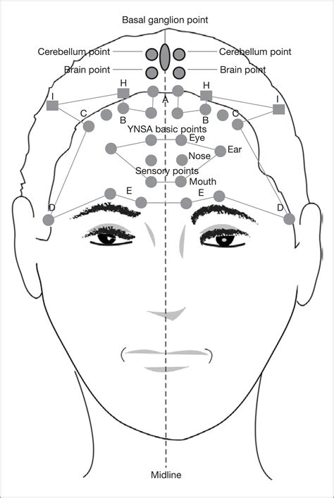 Yamamoto new scalp acupuncture: its applications and ...