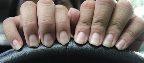 Do Discoloured Nails Mean Something Office For Science And Society