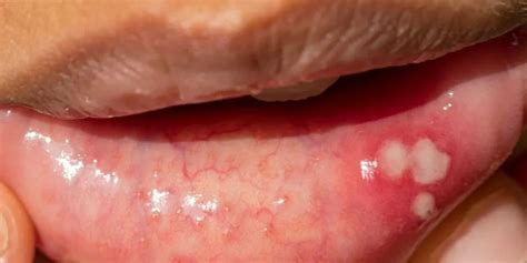 What Causes Sores On The Roof Of Your Mouth