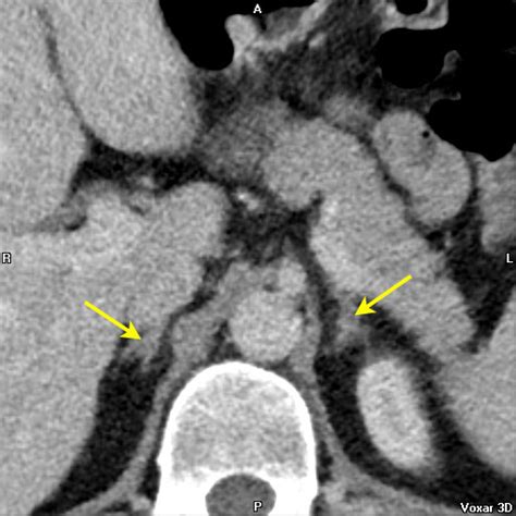 Adrenal Gland Normal Ct Anatomy Image