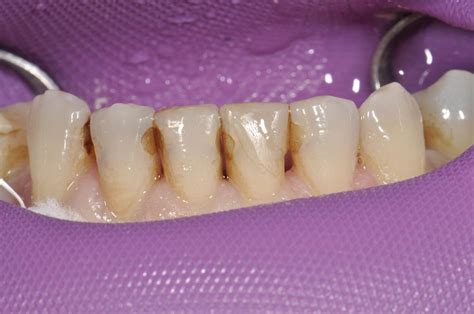 What Does What Is A Composite Filling Magnolia Dental Mean Telegraph
