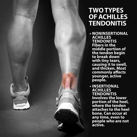 Can I Run With Achilles Tendonitis Achilles Tendon Rupture Injury