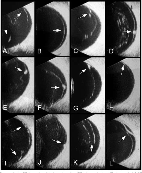 Figure 1 From B Scan Ultrasonography To Screen For Retinal Tears In