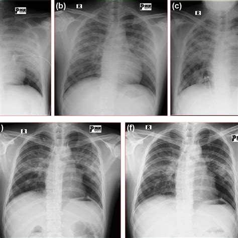Serial Chest X Ray On Hospitalization A Day 1 B Day 4 C Day 7