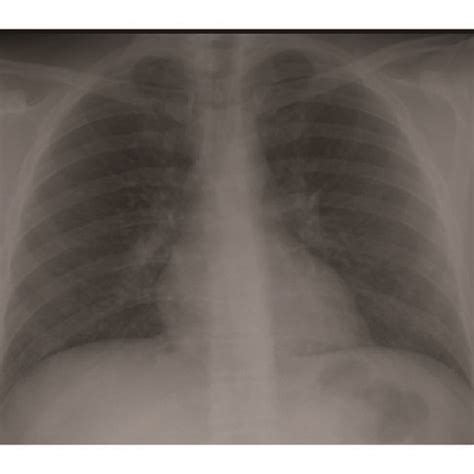 Posteroanterior A And Lateral B Chest X Rays The Chest Radiography