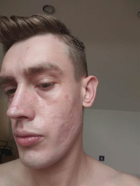 Skin cancer is the most common cancer in the u.s. Skin Concerns These red patches have appeared on my ...
