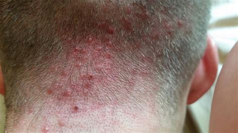 What Is Folliculitis How To Treat It And How It Affects Hair Health