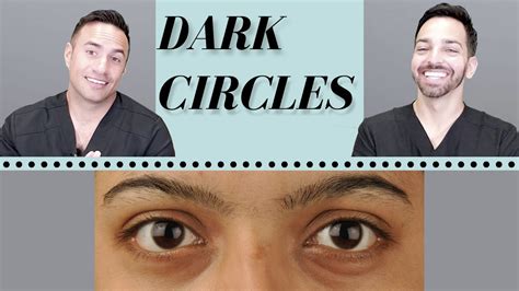 Dark Circles Causes And Treatments Dermatologist Perspective Youtube