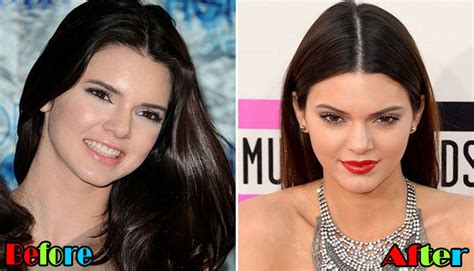 Kendall Jenner Plastic Surgery Before And After Pictures Plastic Surgery Magazine